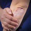 Псориатический артрит